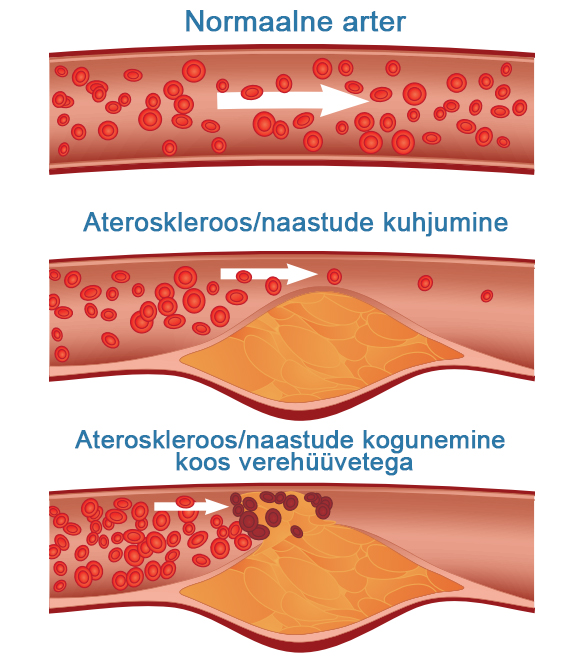 atherosclerosis.jpg