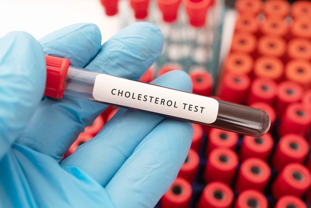 Cholesterol - Blood Test - Do we need to have regular tests?